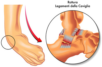 足首の内反捻挫後に続く足首の痛みを足首サポーターで治療する
